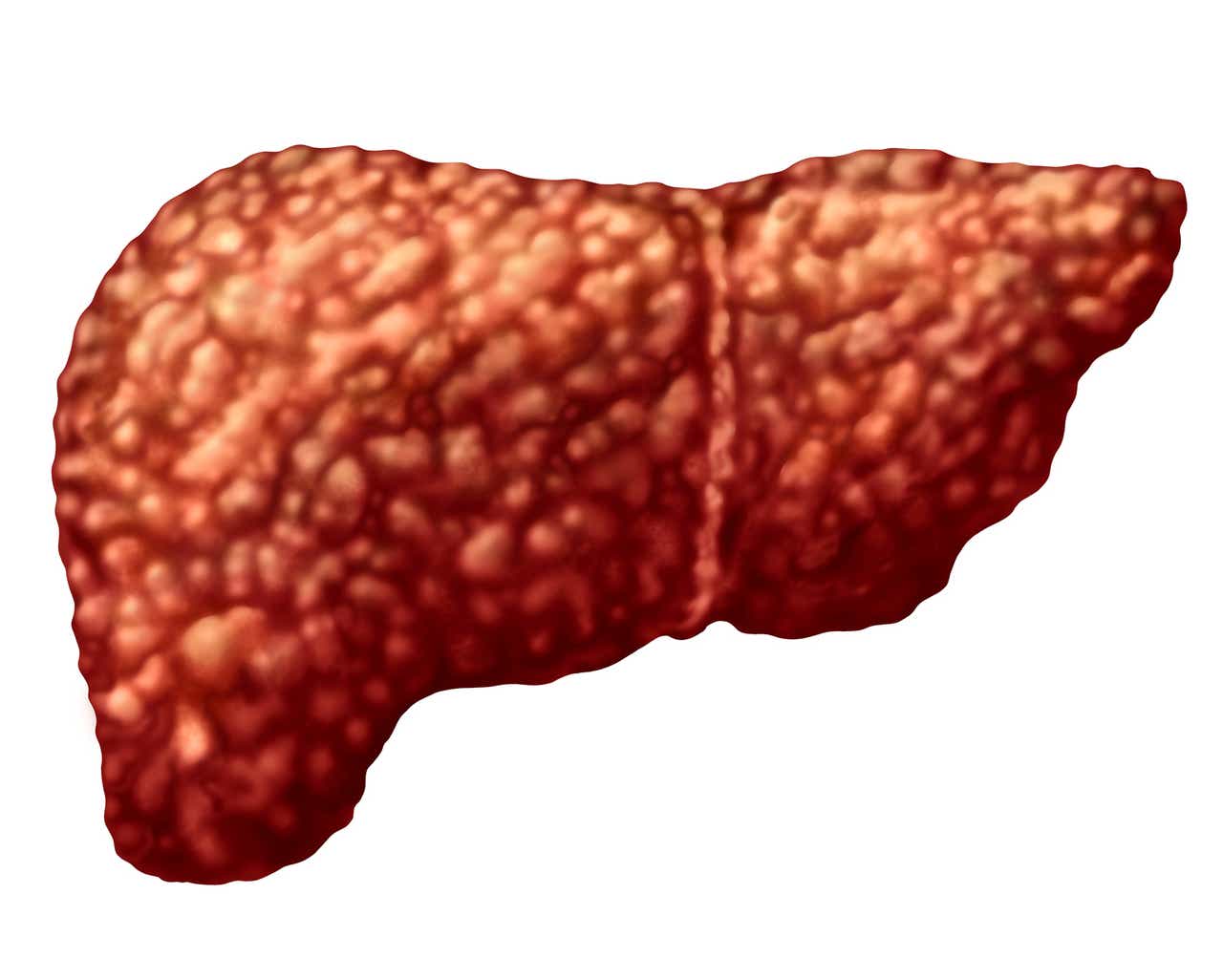 Why did Madrigal Pharma stock drop today? Lilly fatty liver data ...