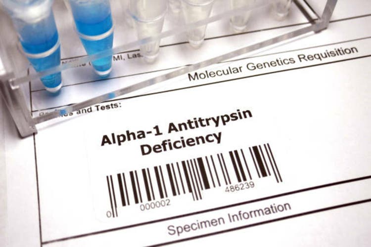 Alpha 1-antitrypsin deficiency