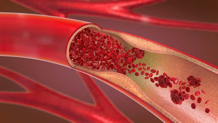 3d illustration of a constricted and narrowed artery and the blood cannot flow properly called arteriosclerosis