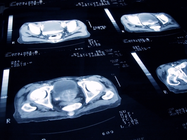 MDxHealth Acquires Oncotype DX Prostate Test From Exact Sciences 