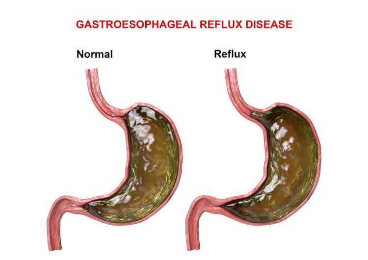 Gastroesophageal Reflux Disease - failure of the digestive mechanism (sphincter) that causes passage of gastric acid into the esophagus