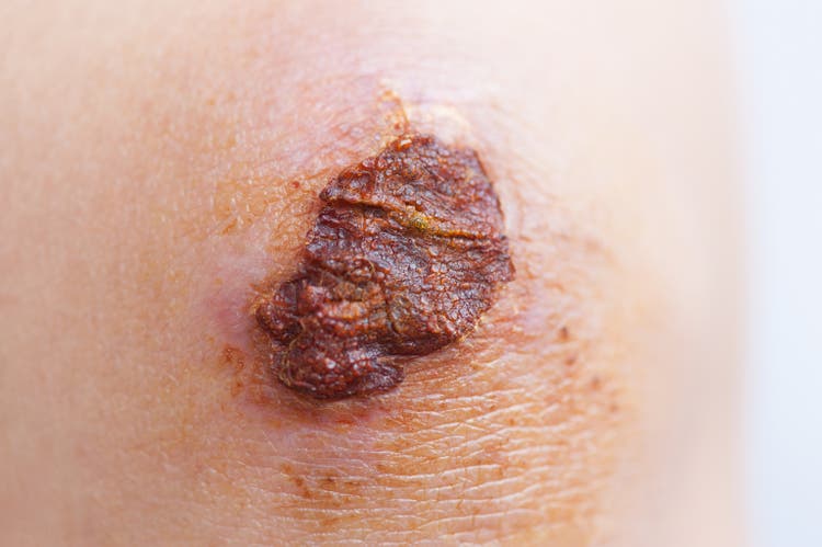Scar and scab (eschar) on asian female knee