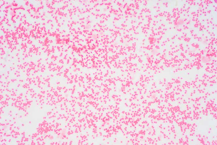 Bone marrow biopsy from myelodysplastic condition under the microscope view. Histology tissue of bone marrow biopsy.