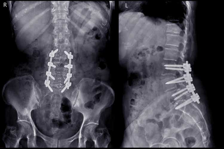 X-ray image of lambosacral spine or L-S spine AP and lateral Post operative Lumbar Plates and screw.