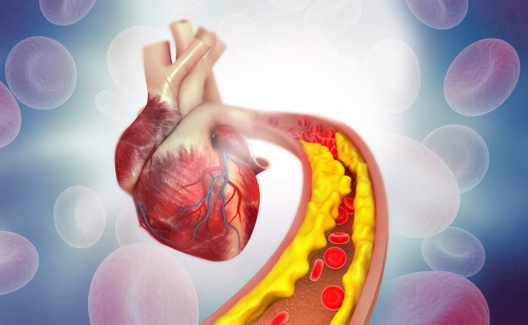 Cholesterol plaque in artery with Human heart anatomy