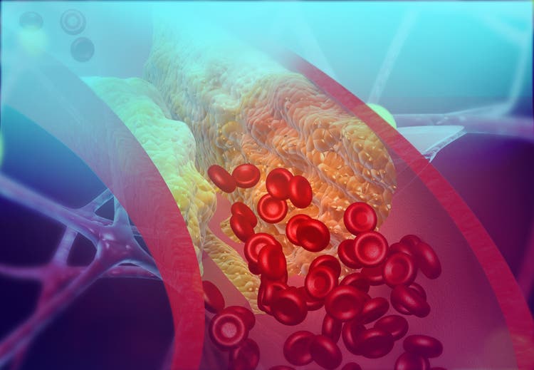 Cholesterol blocking artery