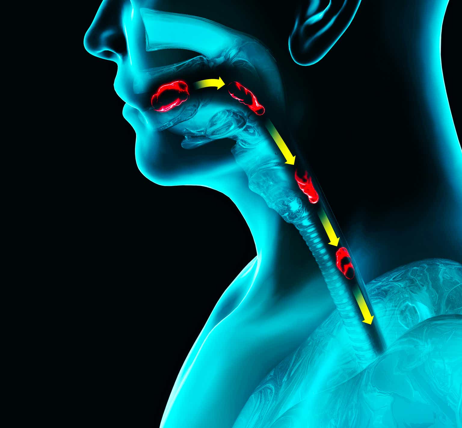 AstraZeneca asthma drug Fasenra fails a main goal in phase 3 trial for ...