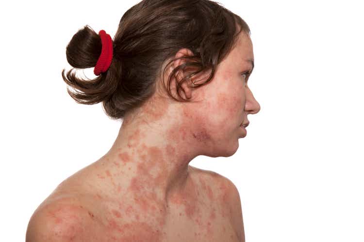 Atopic dermatitis