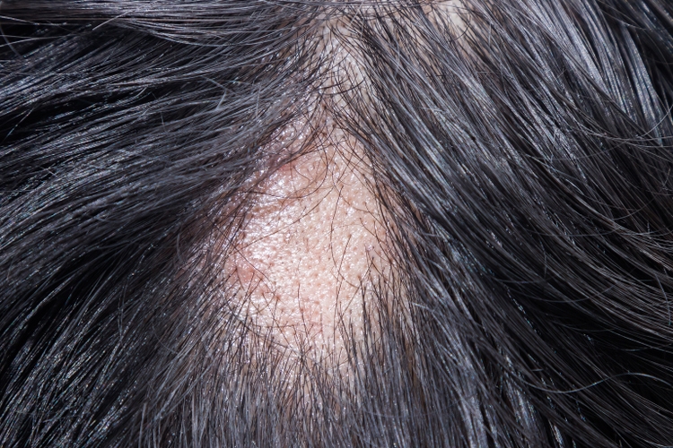 Alopecia Areata - Spot Baldness is a condition in which hair is lost from some or all areas of the body.