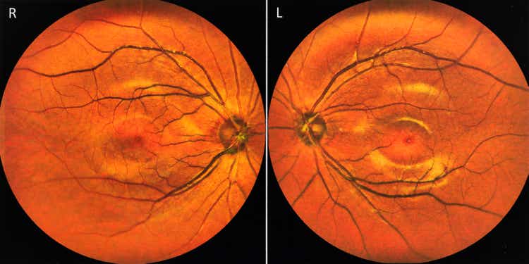 Human optic disc, retina and blood vessels