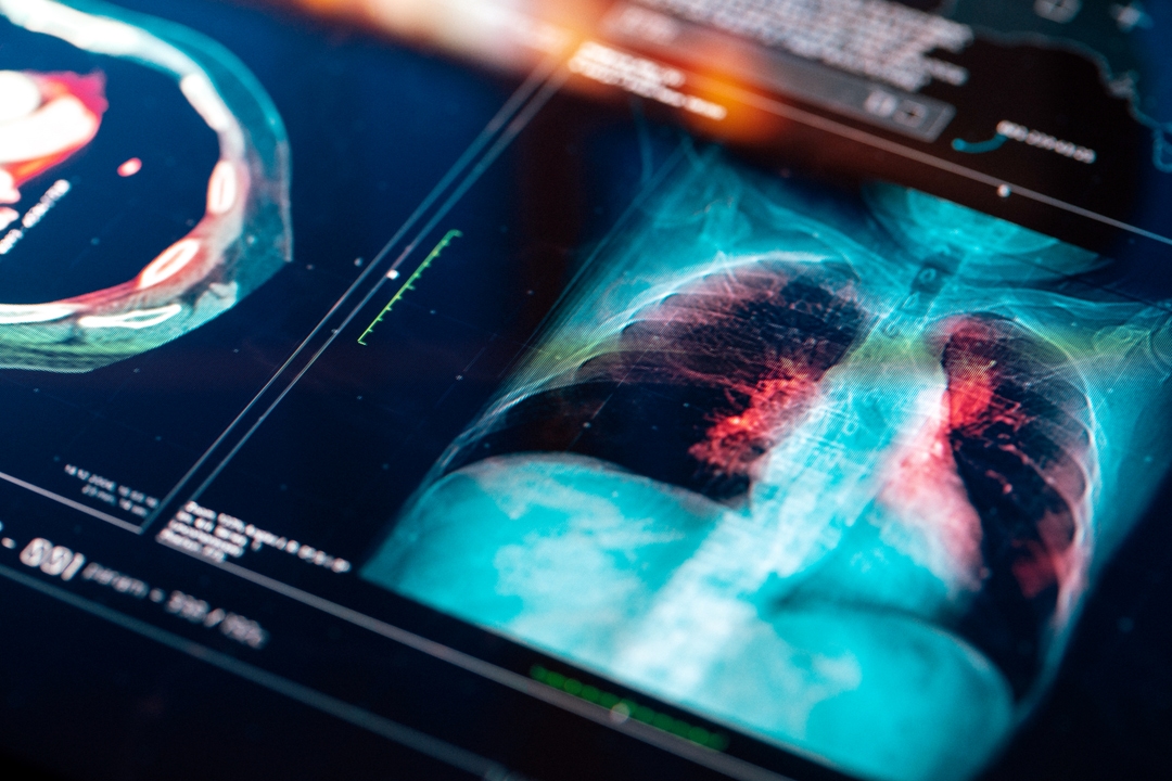 AstraZeneca Imjudo Imfinzi Combo Approved For Non small Cell Lung 
