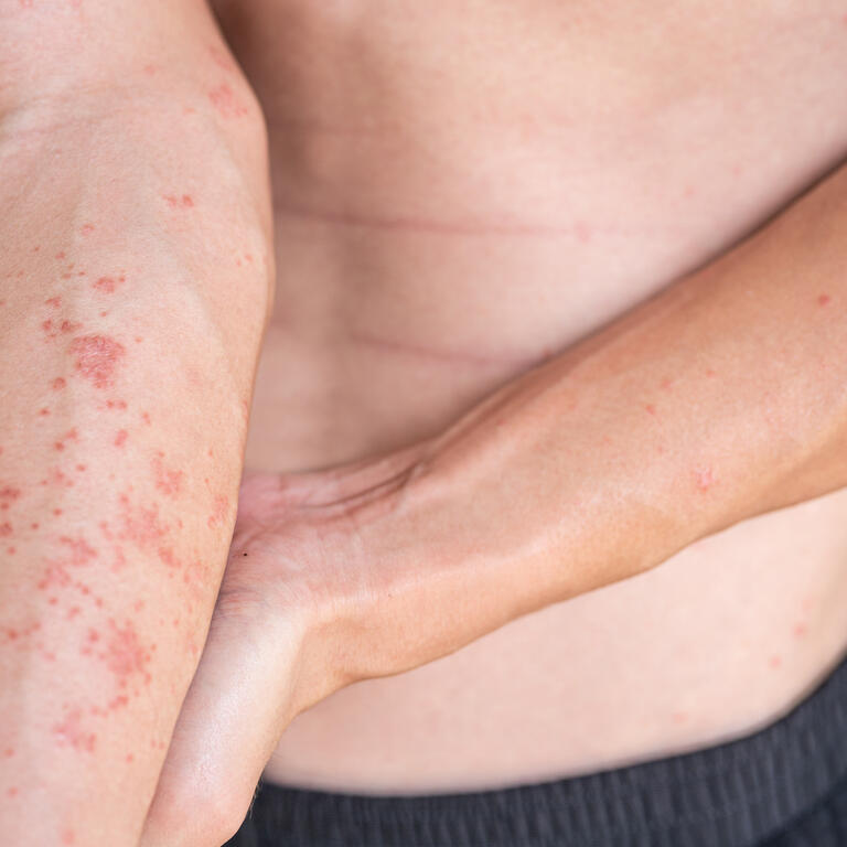 Arm of a man showing skin Atopic dermatitis dry skin problem around body