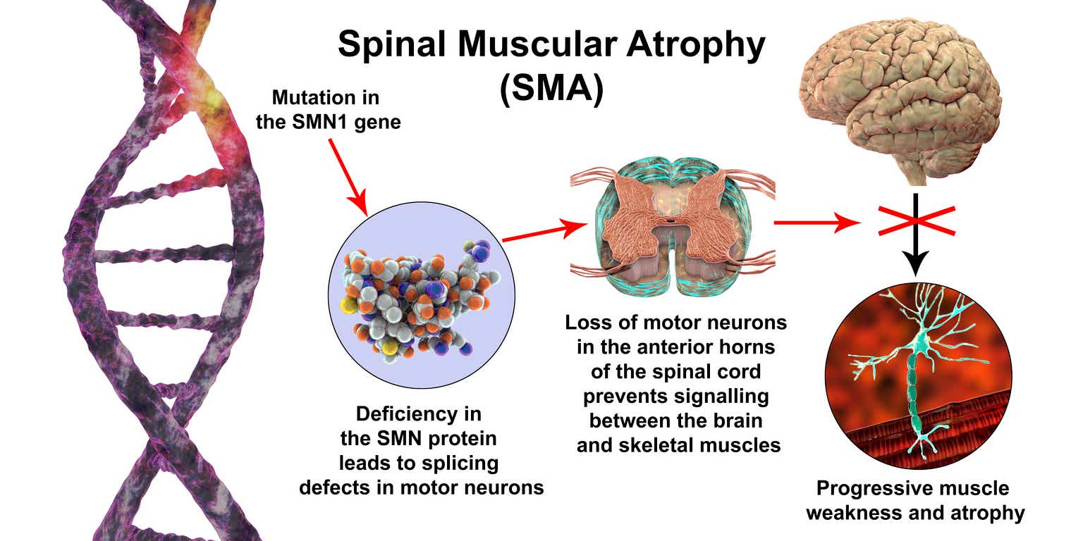 spinal muscular atrophy research paper