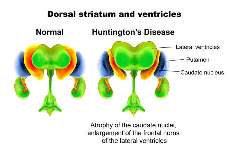 Dorsal striatum and lateral ventricles normal and in Huntington"s disease