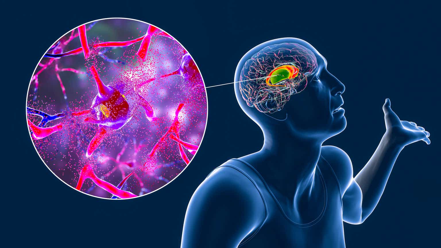 Teva data indicates longterm benefit of Austedo for chorea associated