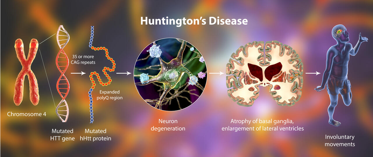 Neurocrine's Ingrezza Meets Primary Endpoint In Late-stage Huntington 