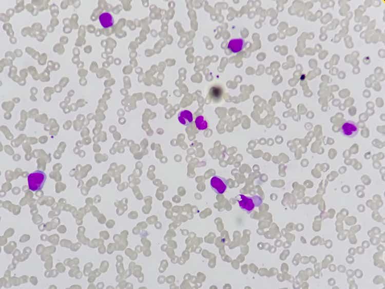 Acute myeloid leukemia (AML).
