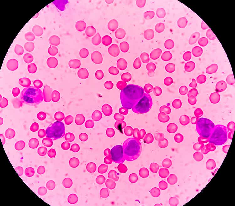 Photomicrograph of Acute Myeloblastic Leukemia (AML), a cancer of white blood cell