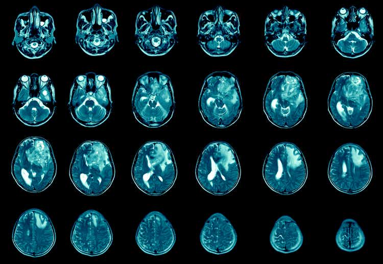 Magnetic resonance imaging Finding 5 cm isodense mass with ill-defined margin and surrounding edema at Left frontal lobe. Glioblastoma, brain metastasis.science and education mri brain background.