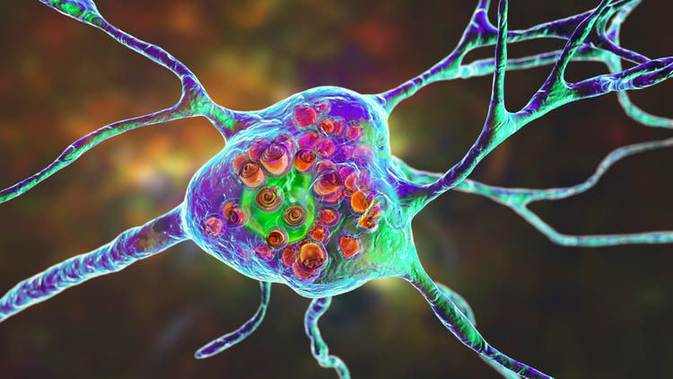 Brain neurons in Tay-Sachs disease, 3D illustration