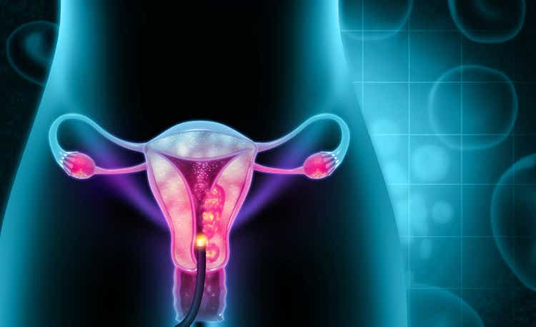 Dilation and curettage (d and c).endometrial biopsy.cervical cancer.3d illustration