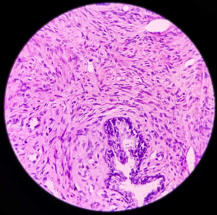 Nodular prostatic hyperplasia. Micrograph show proliferation of fibro muscular and glandular tissue, no malignancy is seen, Photo under microscope