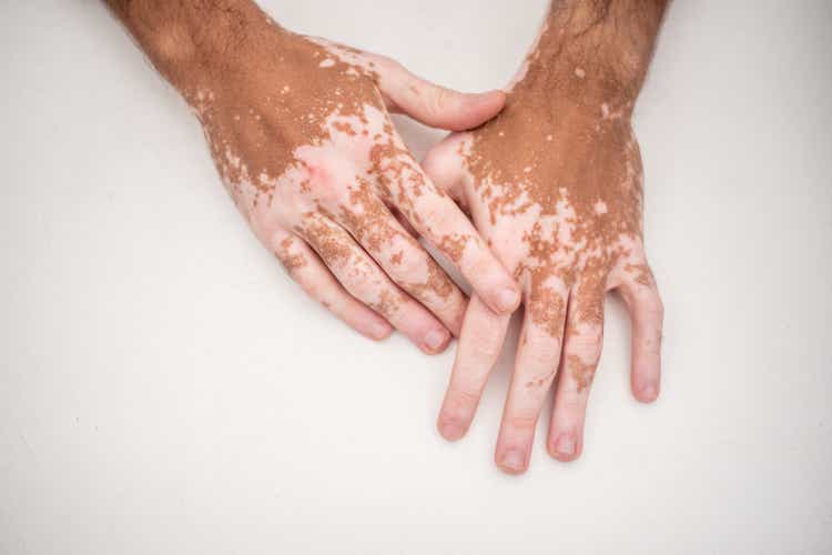 Man"s hand with vitiligo