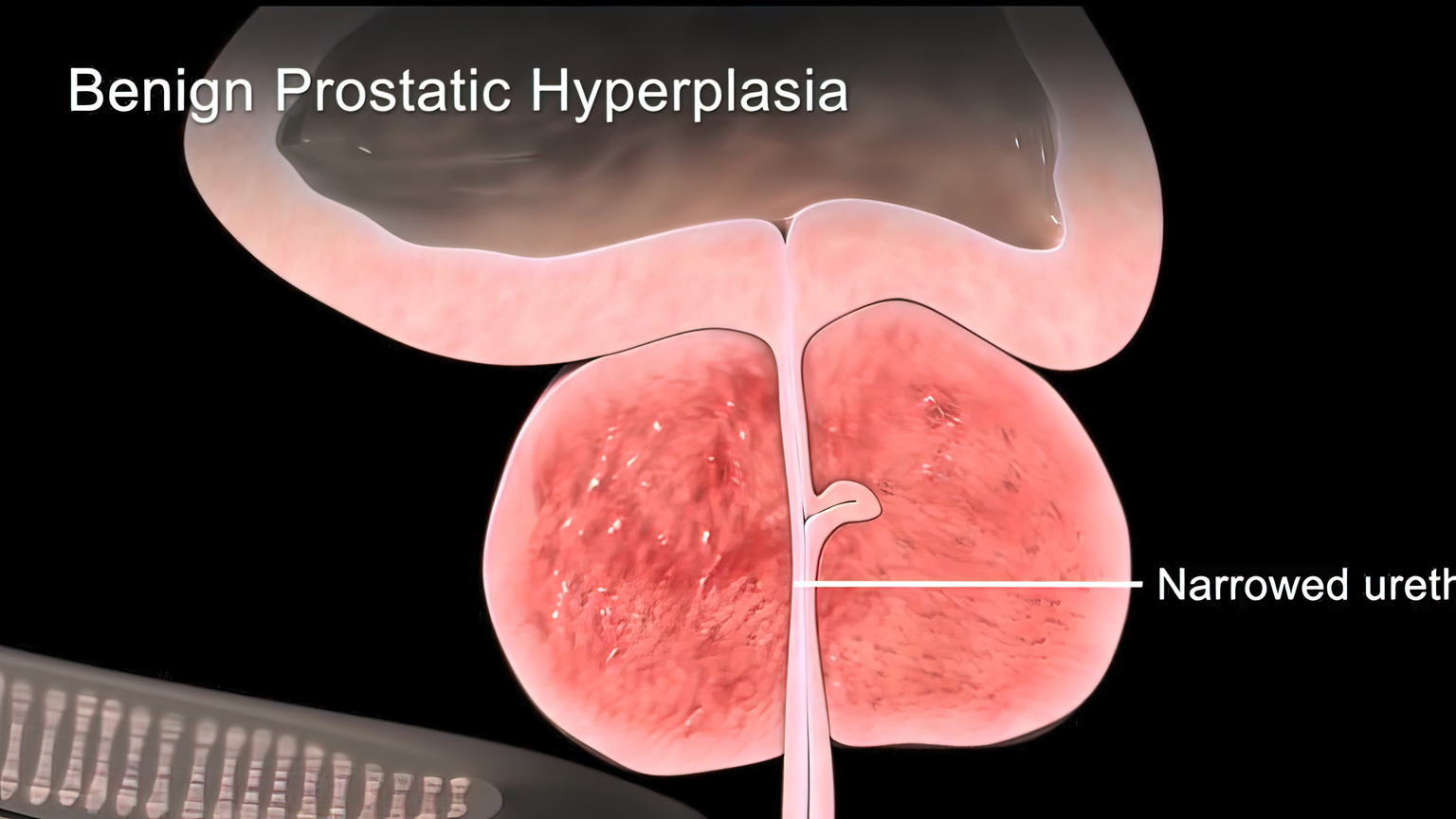 PROCEPT BioRobotics A Buy At Truist On Disrupting BPH Treatment Market ...