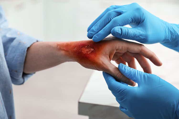 Doctor examining terrible patient"s burn of hand indoors, closeup