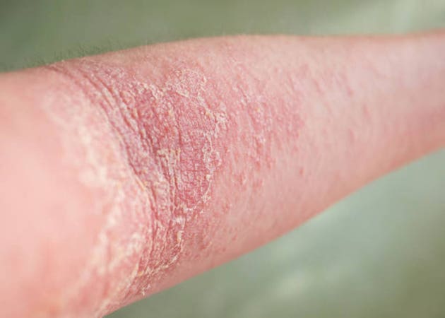 Apogee falls following phase 2 results for zumilokibart in atopic dermatitis