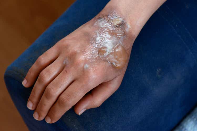 Second degree burnt female hand. severe skin damage