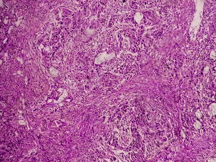 Bladder Cancer: High grade transitional cell carcinoma (<a href='https://seekingalpha.com/symbol/TCC' title='Trammell Crow Company'>TCC</a>), Urothelial carcinoma