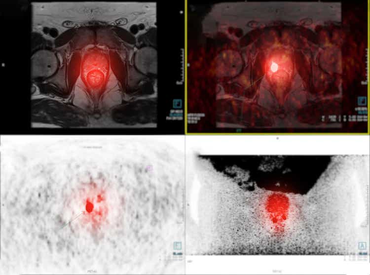 PET scan fusion MRI prostate gland.