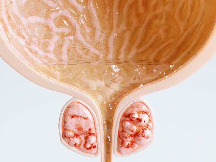 Second stage Prostate Cancer - Close up - 3D Rendering
