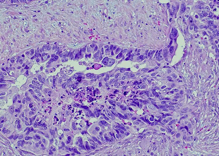 Serous carcinoma, ovary, metastatic soft tissue