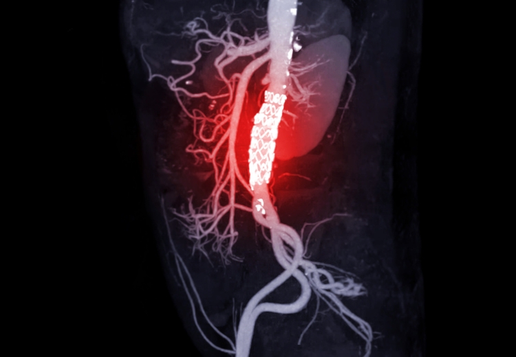 CTA of the abdominal aorta .