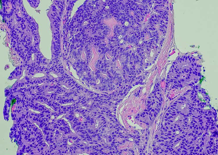 Prostatic adenocarcinoma, Gleason Pattern 4