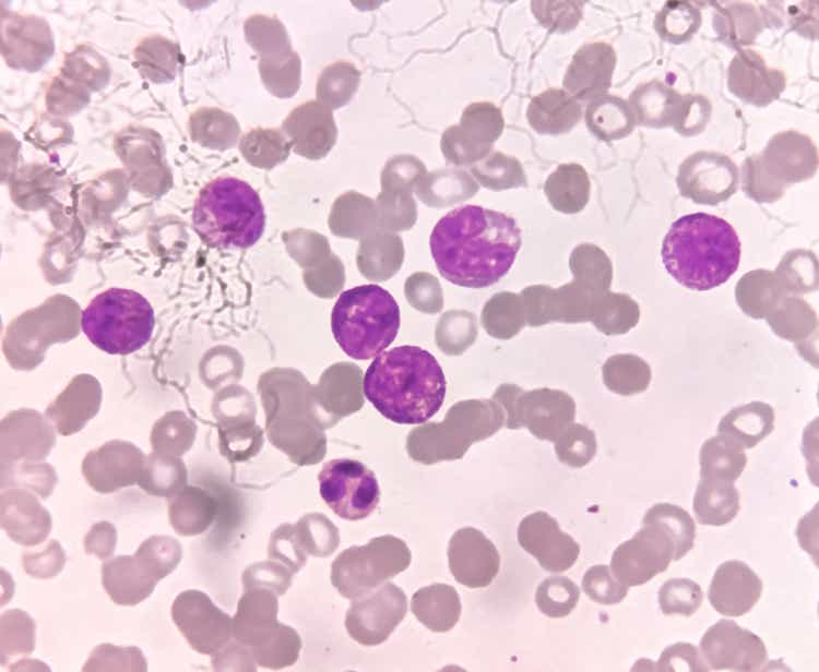 Acute Myeloblastic Leukemia (AML), a cancer of white blood cell