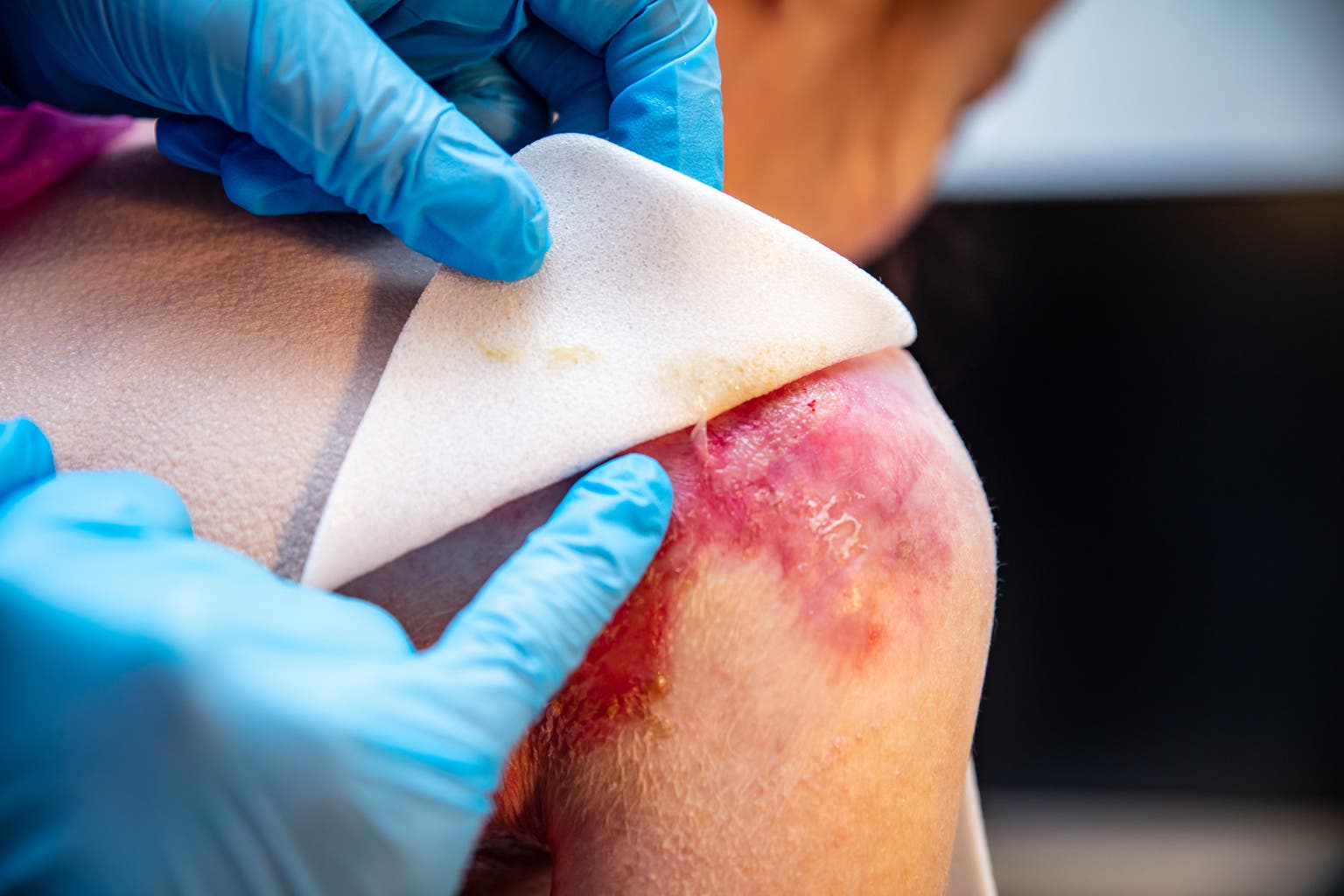 Is Abeona Therapeutics' Zevaskyn Worth $3.1m Per Treatment, Or Will Krystal Biotech Remain The Market Leader?