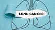 Nuvalent gains breakthrough therapy status for non-small cell lung cancer candidate article thumbnail