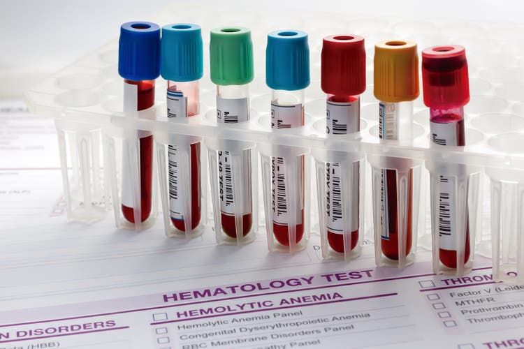 Rack of tubes with blood samples from patients in the hematology lab