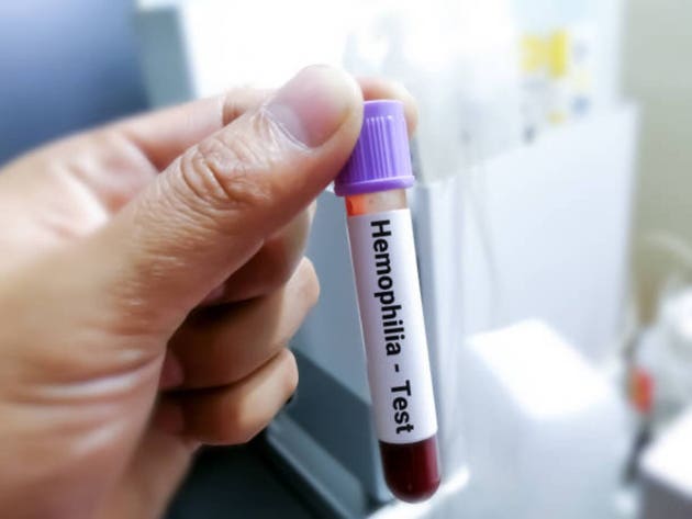 Blood sample for hemophilia test, inherited genetic bleeding disorder