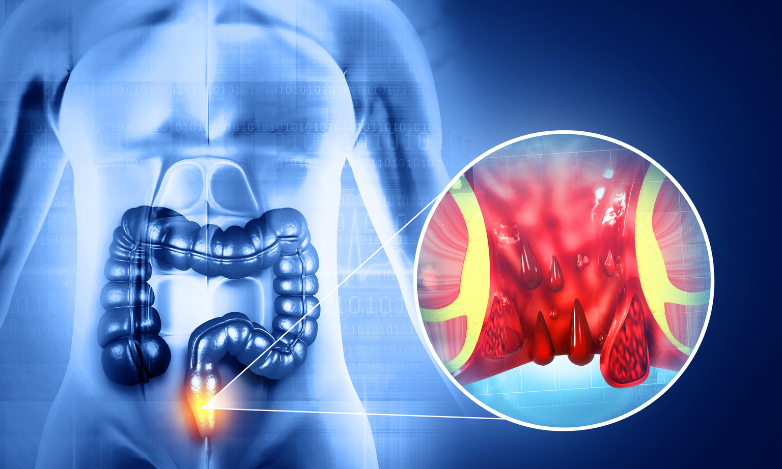 Citius Gains On Positive Mid Stage Data For Hemorrhoids Therapy NASDAQ   Image 1448517511 