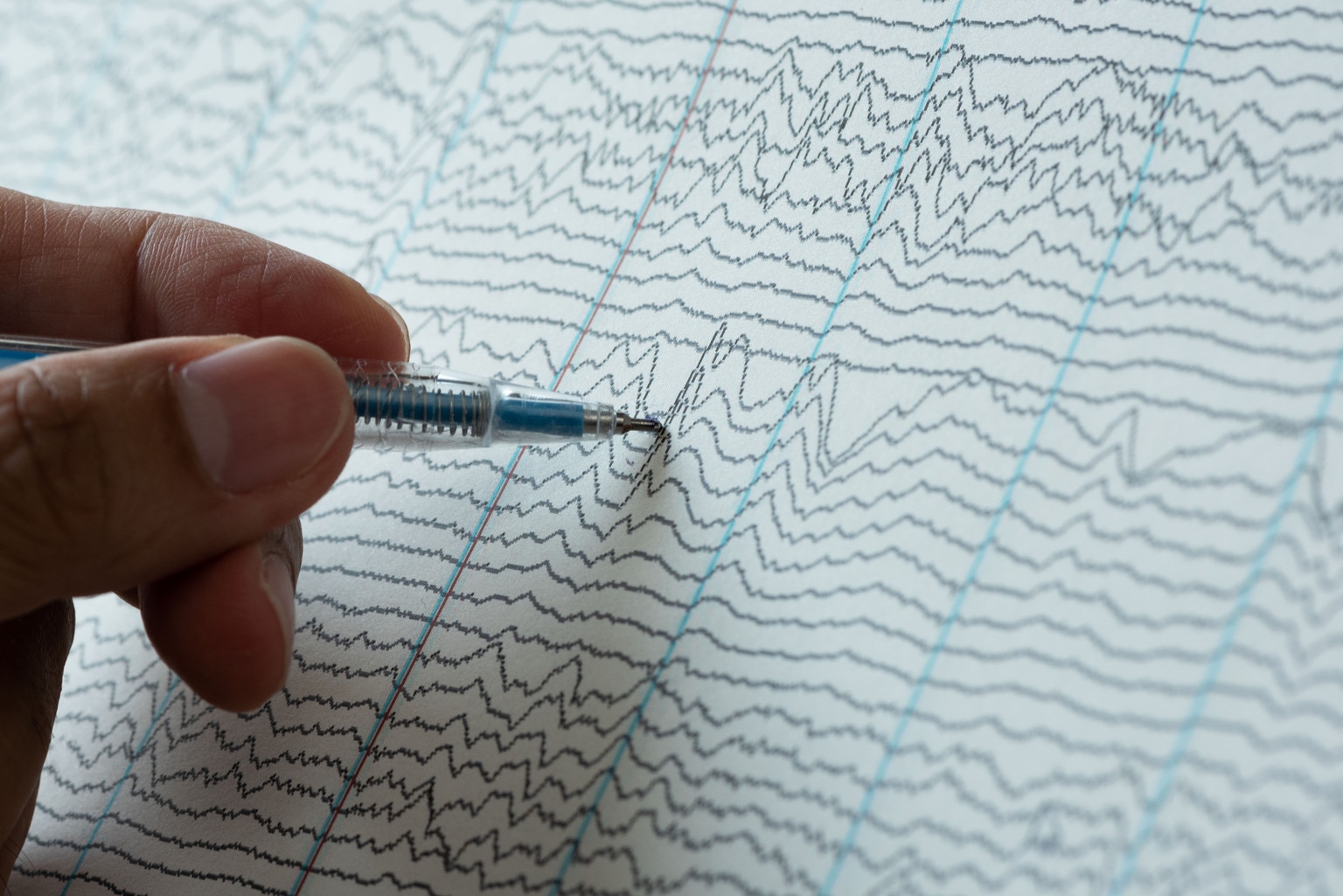 Xenon: XEN1101 Remains A Gem Despite The Dip (NASDAQ:XENE) | Seeking Alpha