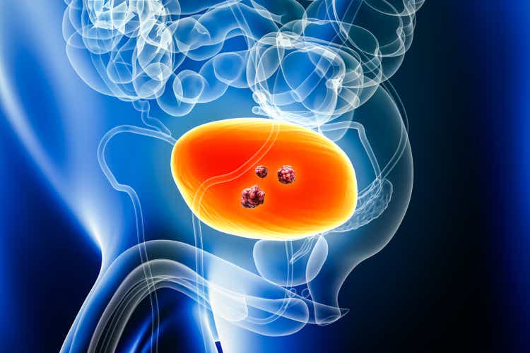 Bladder cancer with organ and tumor or cancer cells 3D rendering illustration with male body. Anatomy, oncology, biomedicine, disease, medicine, biology, science, healthcare concept.