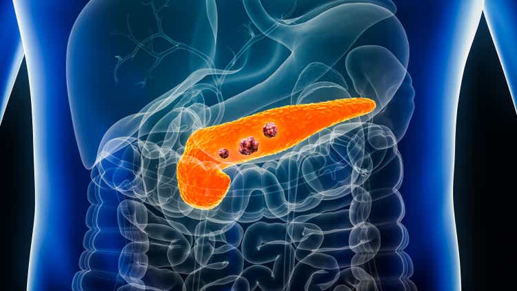 Pancreas or pancreatic cancer with organs and tumors or cancerous cells 3D rendering illustration with male body. Anatomy, oncology, disease, medical, biology, science, healthcare concepts.