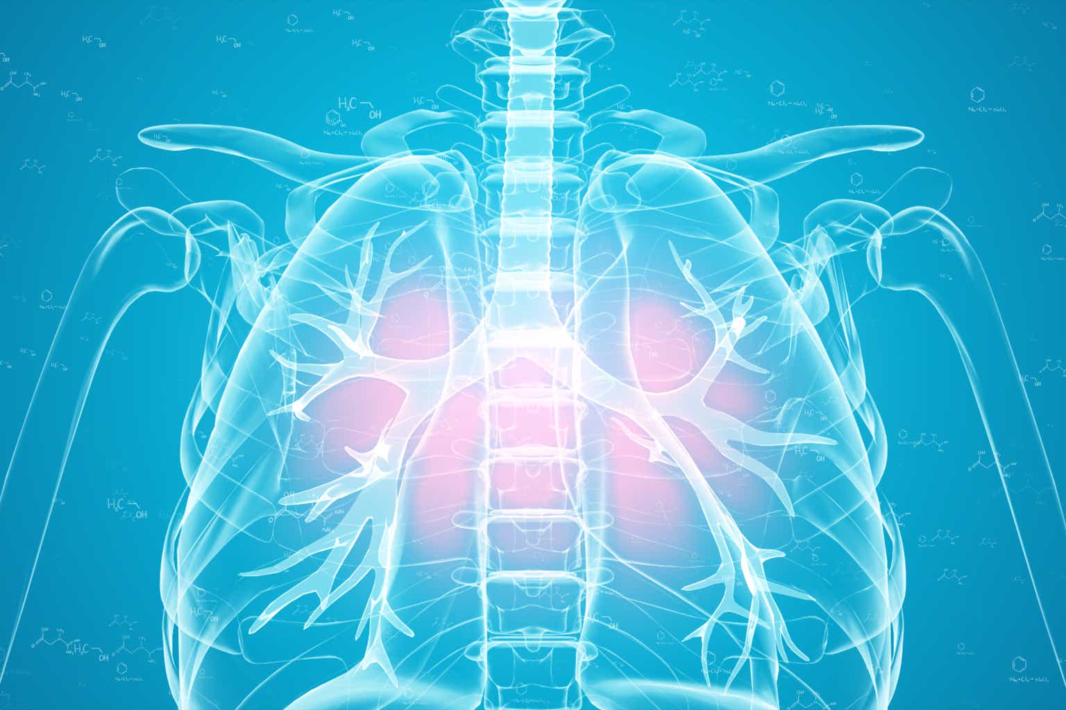 Pulmonx: Revisiting Thesis Following Management Change (NASDAQ:LUNG ...