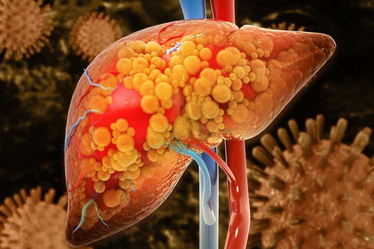 Delcath's PDOA of Hepzato Kit Will Skyrocket Flatter Than The Market Appreciates 1 Liver damage such as Fatty liver, Fibrosis, Cirrhosis, and Liver cancer. 3d illustration