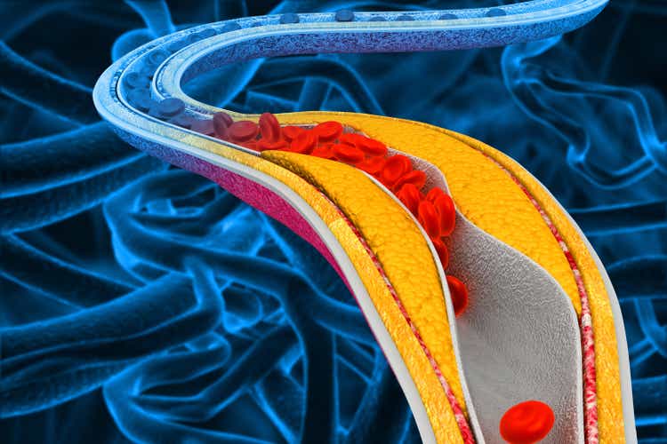 Cholesterin blockierte Arterie. Die Ansammlung von Cholesterin in den Blutgefäßen. 3D-Illustration