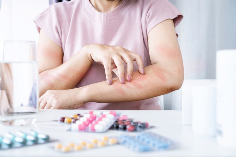 Woman"s Allergic Reaction to Medication: Scratching Itchy Skin on Arm from Side Effects